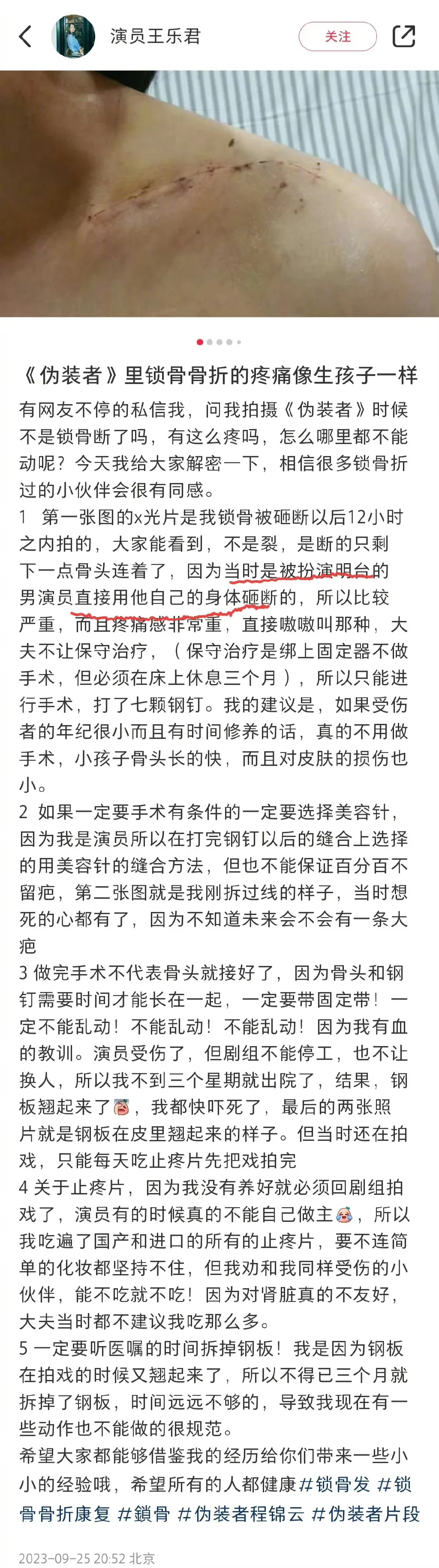 王乐君自曝拍戏时被胡歌砸断锁骨 事后自己找医院手术封面图